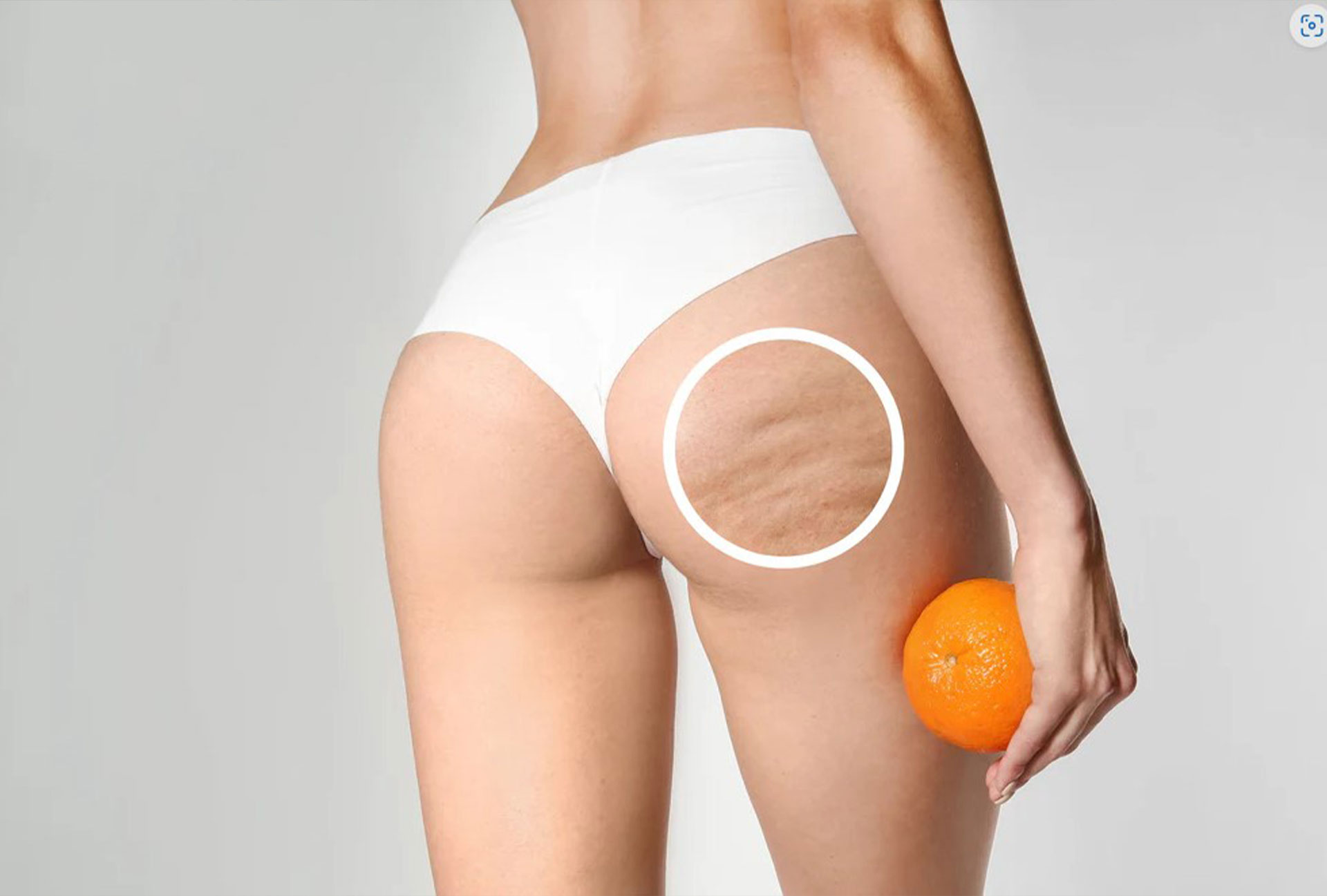Il trattamento della cellulite 